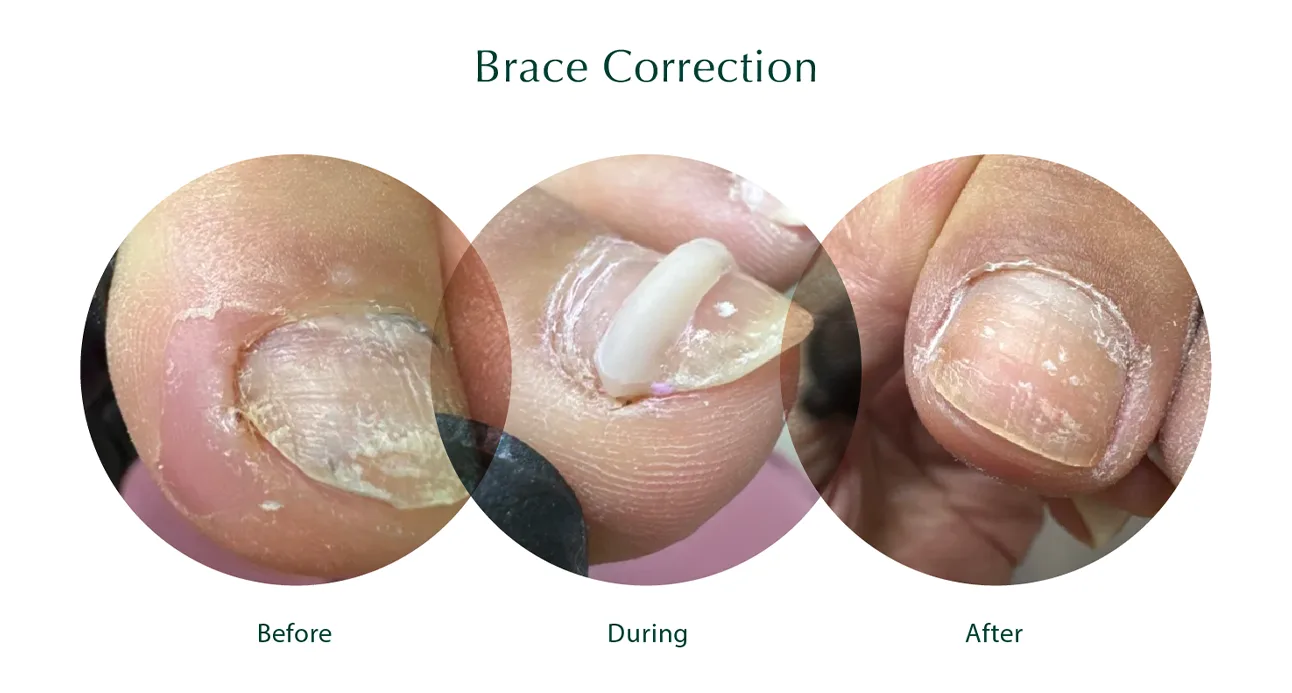 Brace Correction