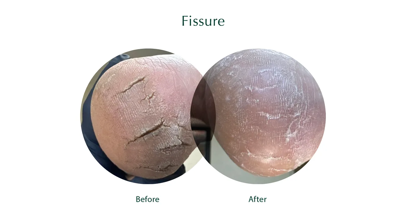 Fissure