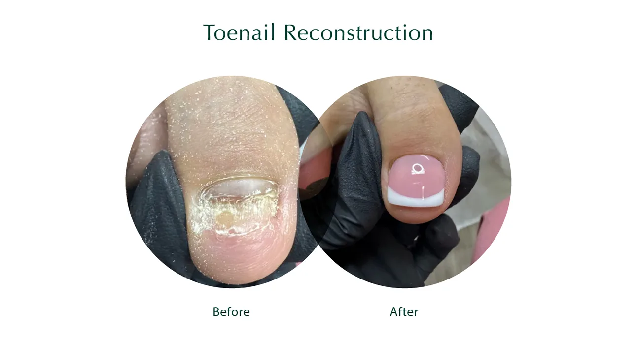 Toenail Reconstruction